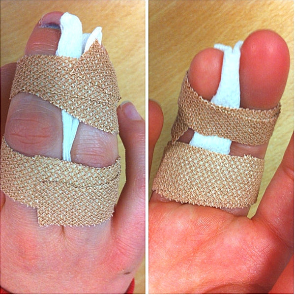 The Long-Term Consequences of Finger Injuries in Sports: Why “Just a Jammed Finger” Can Become a Big Problem