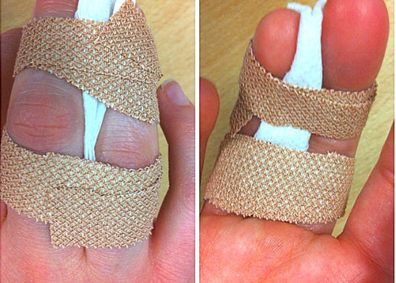 The Long-Term Consequences of Finger Injuries in Sports: Why “Just a Jammed Finger” Can Become a Big Problem