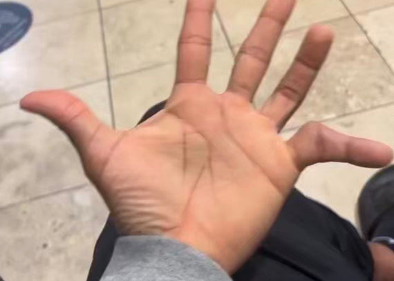 How to Prevent Pinky Injuries in Sports.