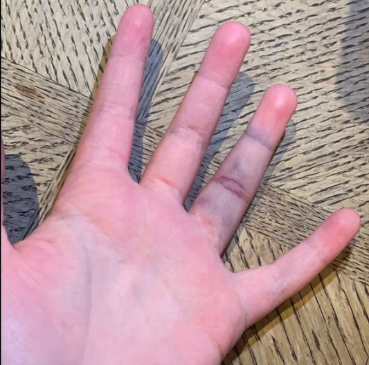 The Long-Term Consequences of Finger Injuries in Sports (And Why They’re More Serious Than You Think)