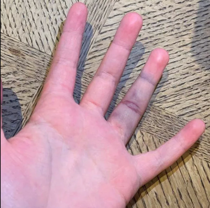 The Long-Term Consequences of Finger Injuries in Sports (And Why They’re More Serious Than You Think)