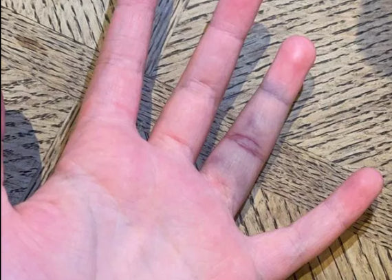 The Long-Term Consequences of Finger Injuries in Sports (And Why They’re More Serious Than You Think)